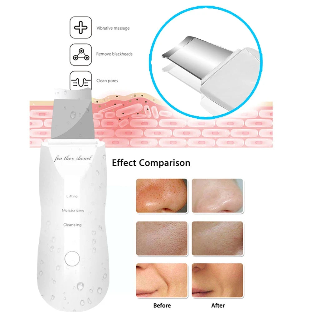 skin Peeling Machine - MONLANE