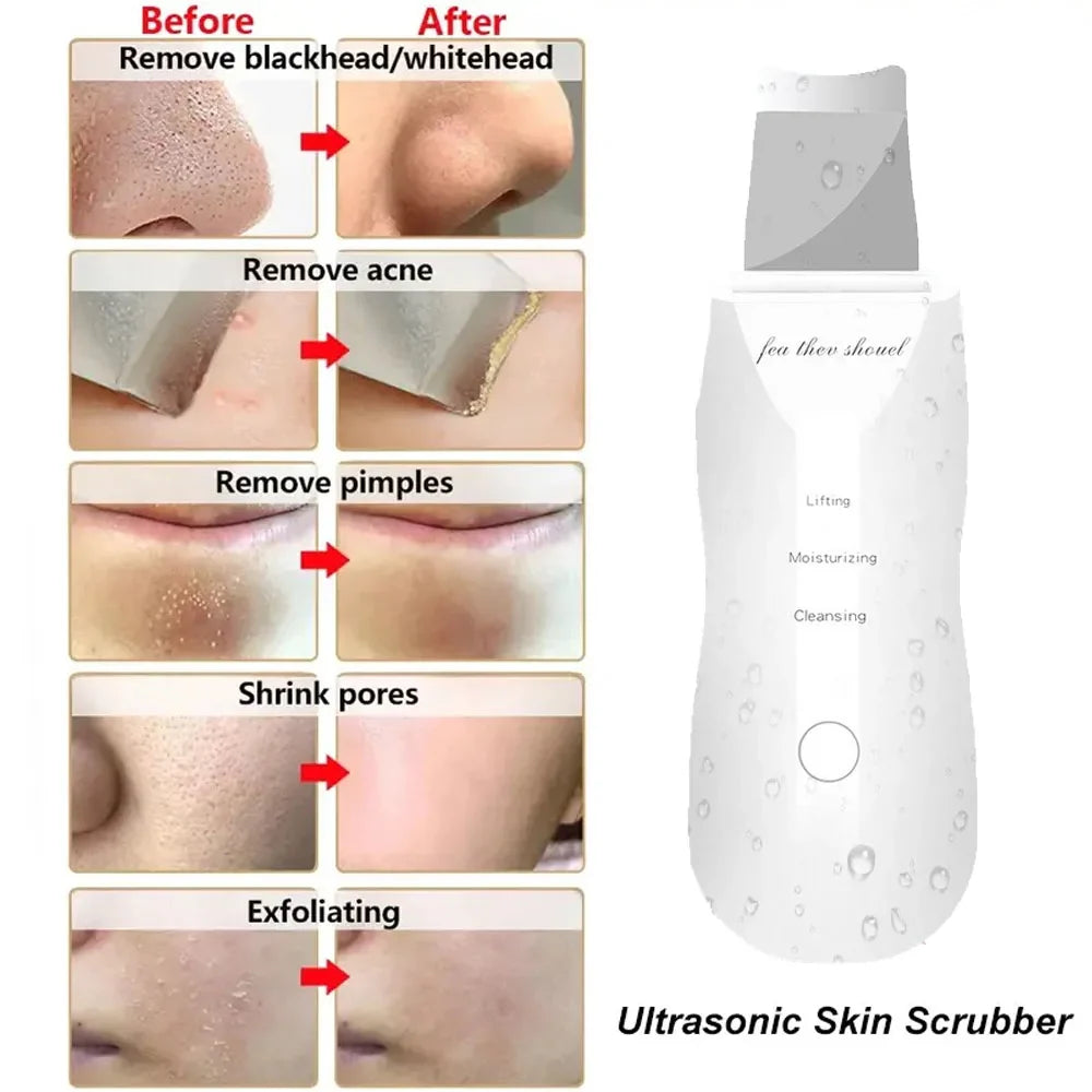 skin Peeling Machine - MONLANE