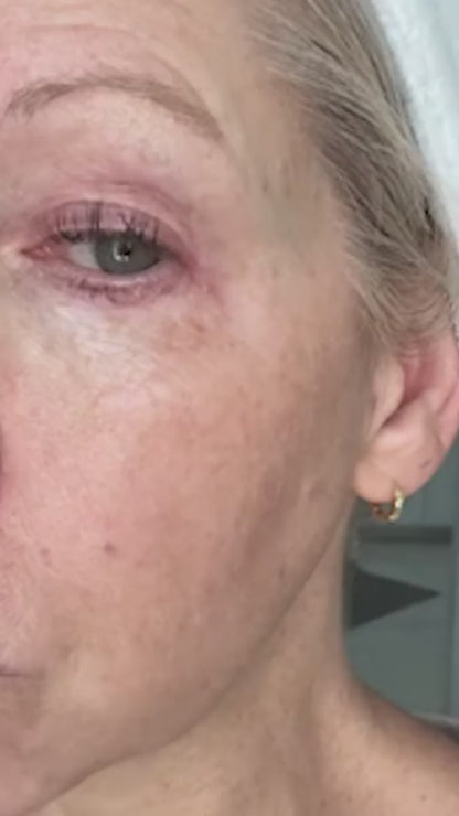 skin Peeling Machine